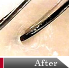 �w�b�h�X�p������f�g�b�N�X�P�A�@After